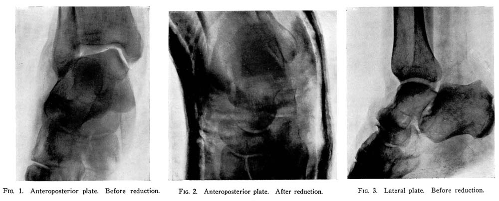 X-rays of a left tarsal dislocation, 1933.