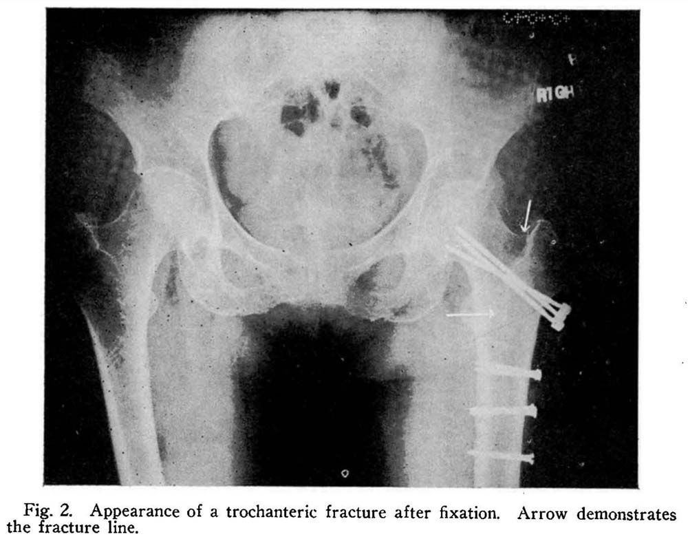 X-ray from a 1944 case study by Dr. Harmon on stainless steel screws.