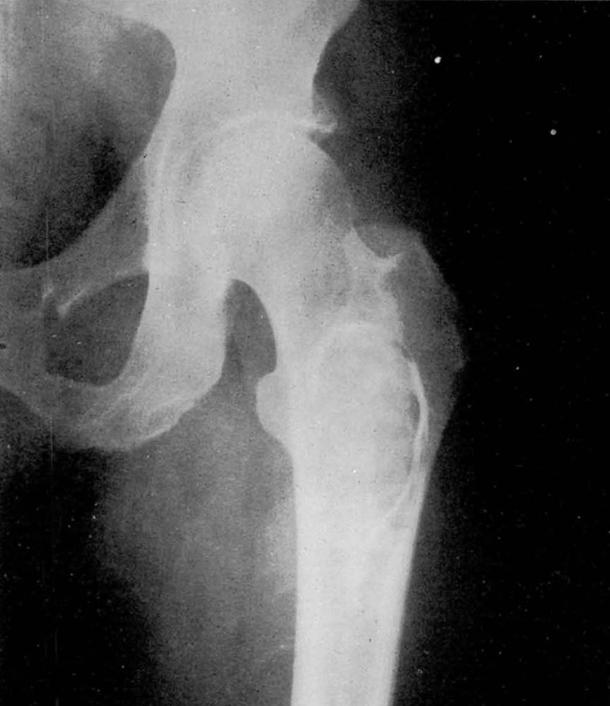 Imaging from a 1951 case report by Chief Dr. Dan Baker emphasizing the value of a bone bank. In this case, specimens had been refrigerated for 328 days and were used to pack the cavity of a large benign bone cyst on the femur.