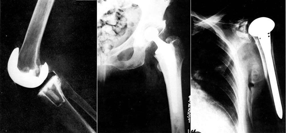 Total joint replacements, 1983.