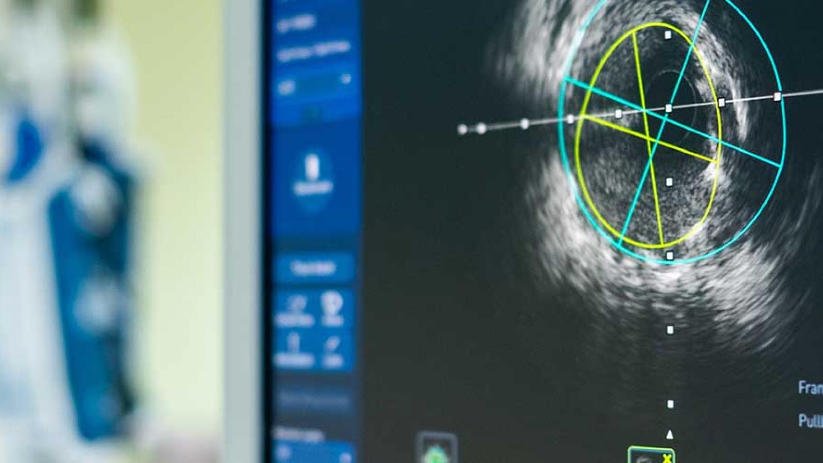 Electrophysiology and Pacing