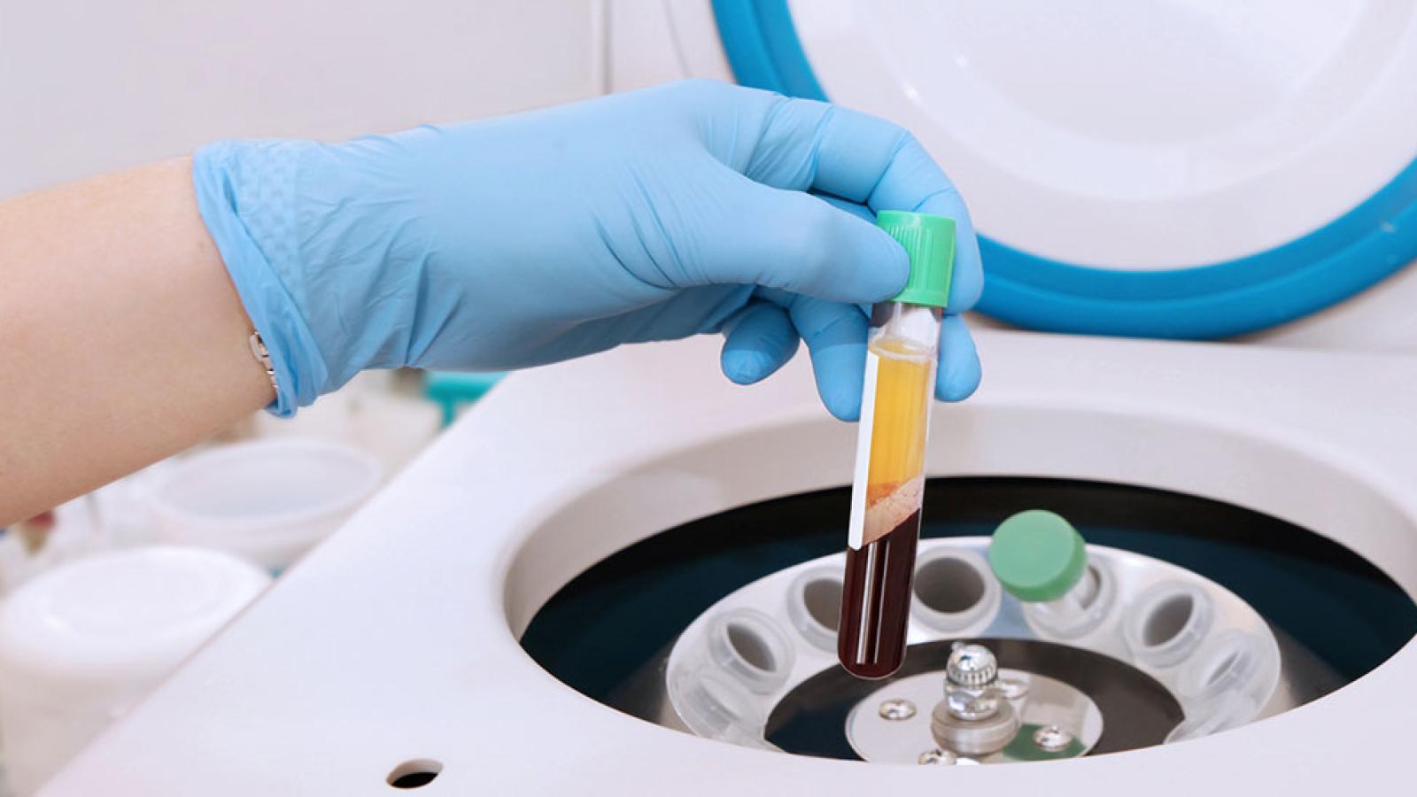 Platelet Rich Plasma (PRP) injections 