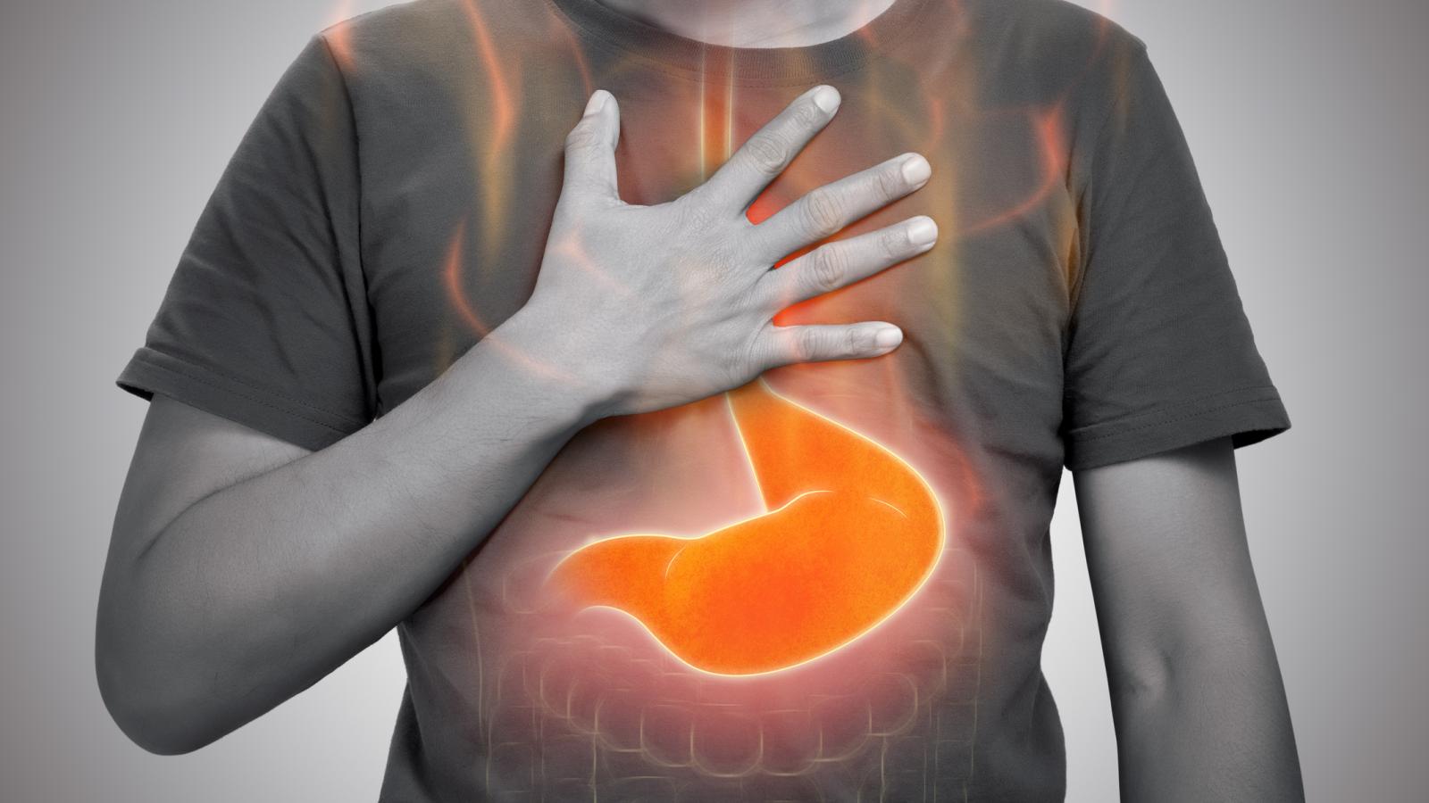 Acid Reflux Q&A