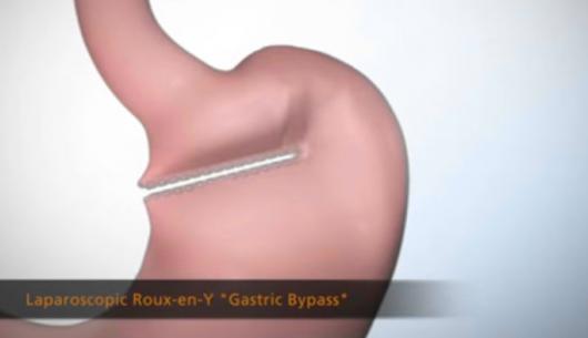 Roux-en-Y Gastric Bypass