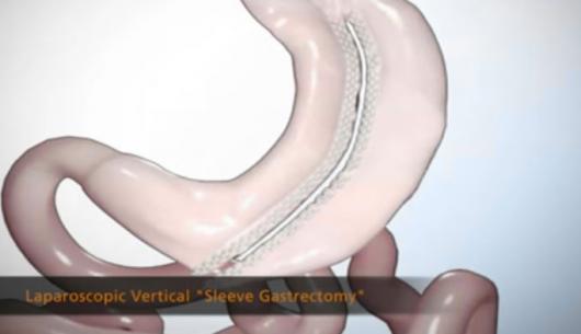 Laparoscopic Sleeve Gastrectomy