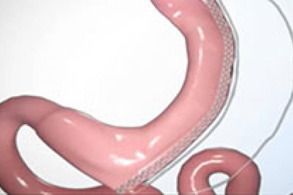 Laparoscopic Sleeve Gastrectomy